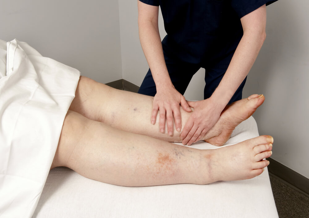 Treatment for lymphedema in New Bern, NC shutterstock 564749302 Treatment for lymphedema in New Bern, NC