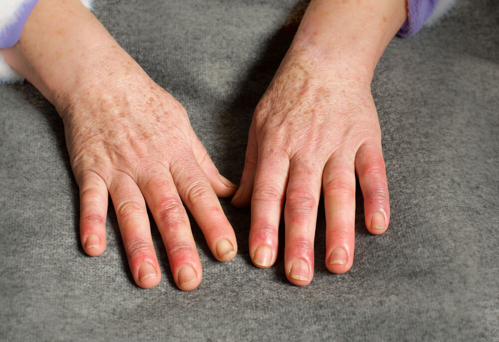 What Is Onychomycosis (Nail Fungus), and What Does It Look Like? - GoodRx