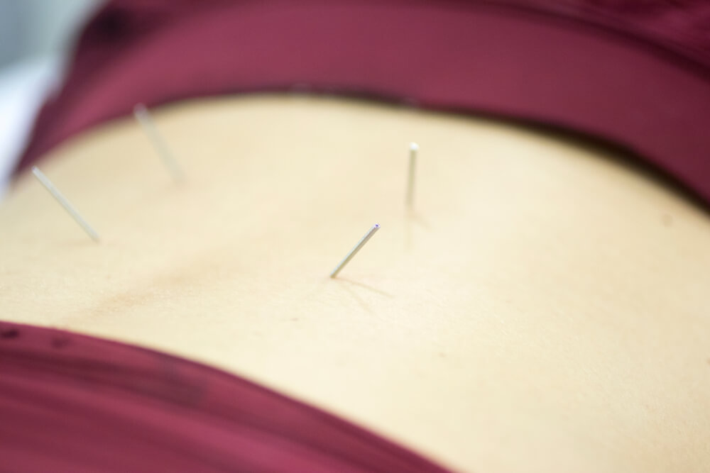 Why is my physical therapist talking about using dry needling for my sciatica? shutterstock 1252713871 dry needling for sciatica