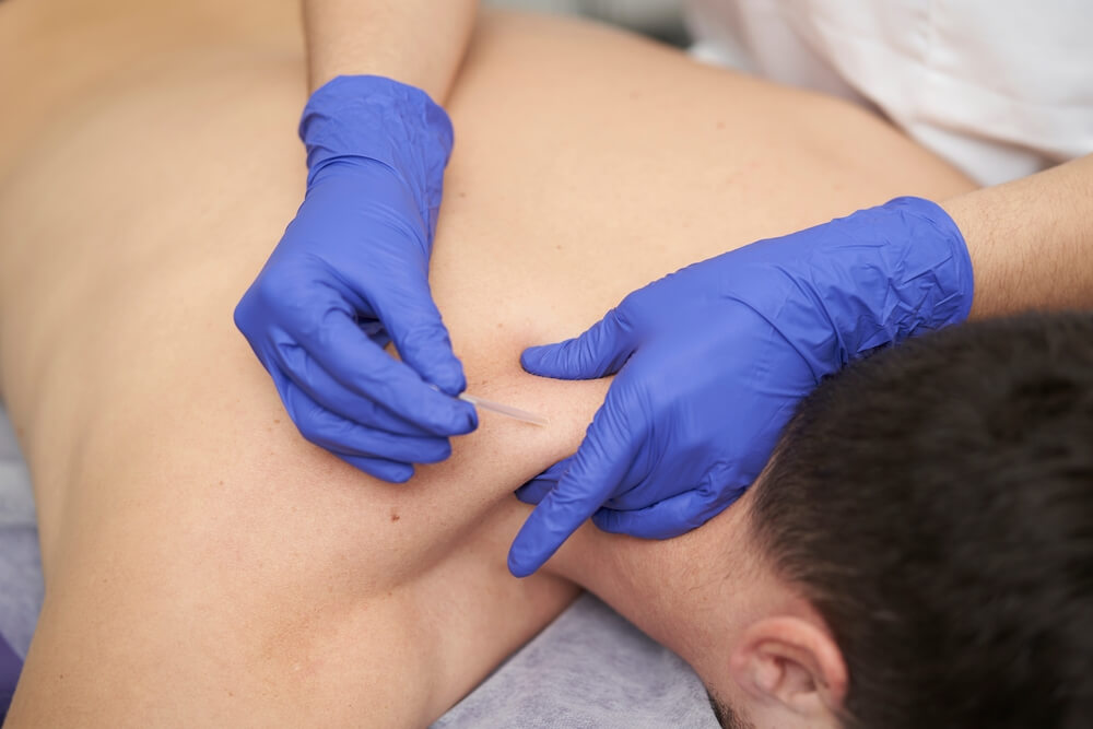 Dry Needling Near Me Advent Physical Therapy Dry needling near me advent physical therapy